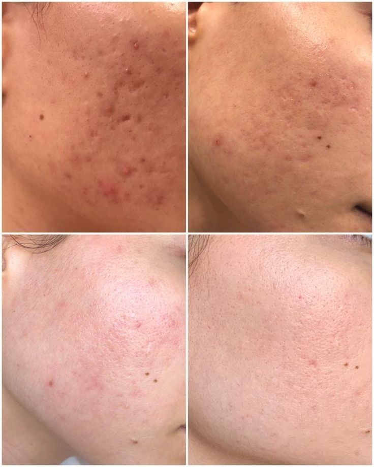 White Max Brightening Pack – Powered by Niacinamide, Glutathione & Vitamin C