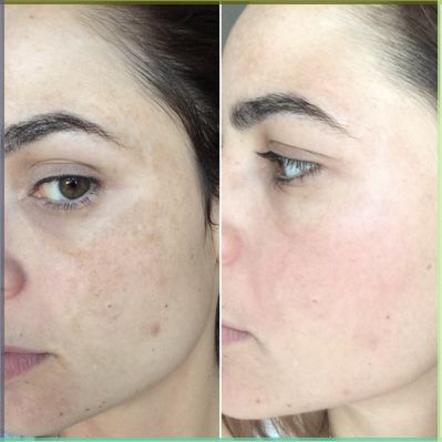 White Max Brightening Pack – Powered by Niacinamide, Glutathione & Vitamin C